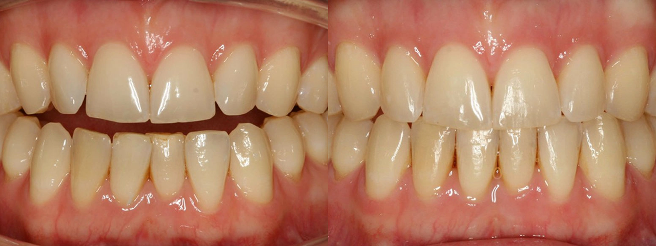 Caso Invisalign