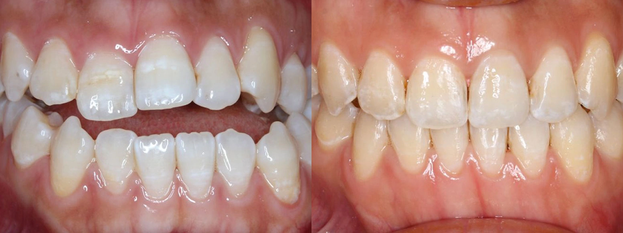 Caso Invisalign