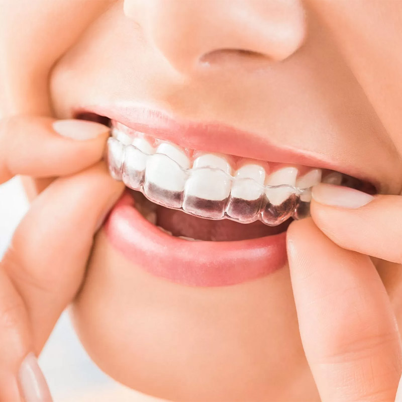 Como funciona Invisalign
